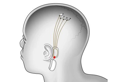 Elon Musk's Neuralink sounds like it's got medical advancement down pat. But can the brain chip really hold that much for the future?